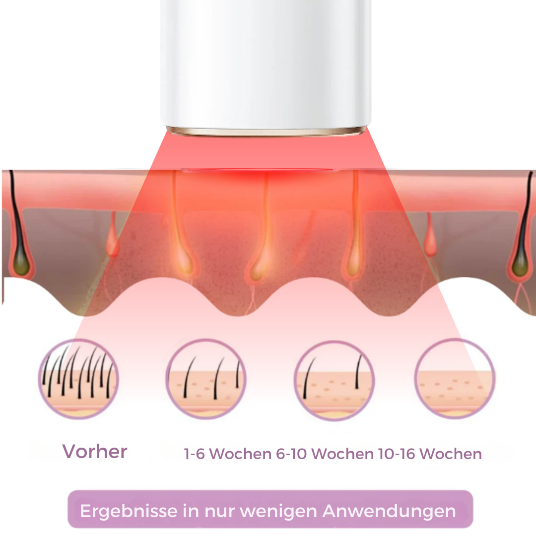Eisstrahl IPL – luxuriöser Laser, 60 % Rabatt! Nur für kurze Zeit!